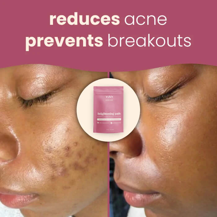 YUVY™ Brightening Turmeric & Kojic Acid Pads